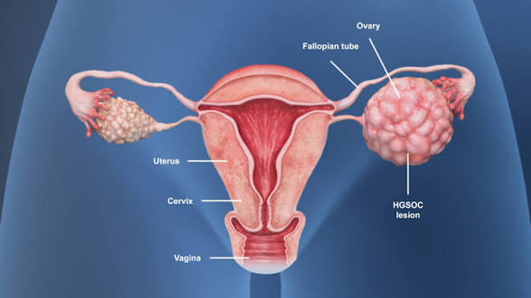 Drug To Reduce Aggressive Ovarian Cancer Found